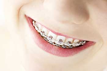 Braces in Mattituck