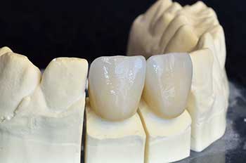 Ceramic Crowns in Mattituck