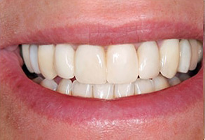 Before and After Invisalign in Mattituck