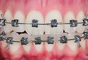 Before and After Dental braces in Mattituck