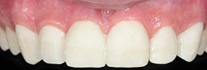 Mattituck Before and After Veneers