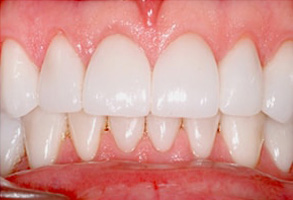 Mattituck Before and After Dental Fillings