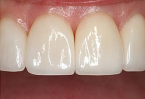 Before and After Dental Bleaching in Mattituck