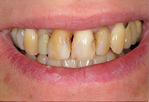 Mattituck Before and After Invisalign