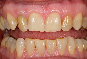 Before and After Dental Implants in Mattituck