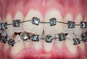 Mattituck Before and After Dental braces