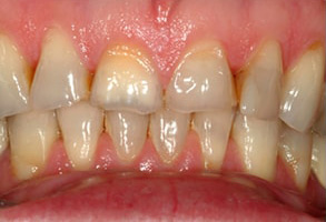 Before and After Dental Fillings in Mattituck