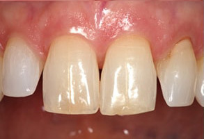 Mattituck Before and After Dental Bleaching